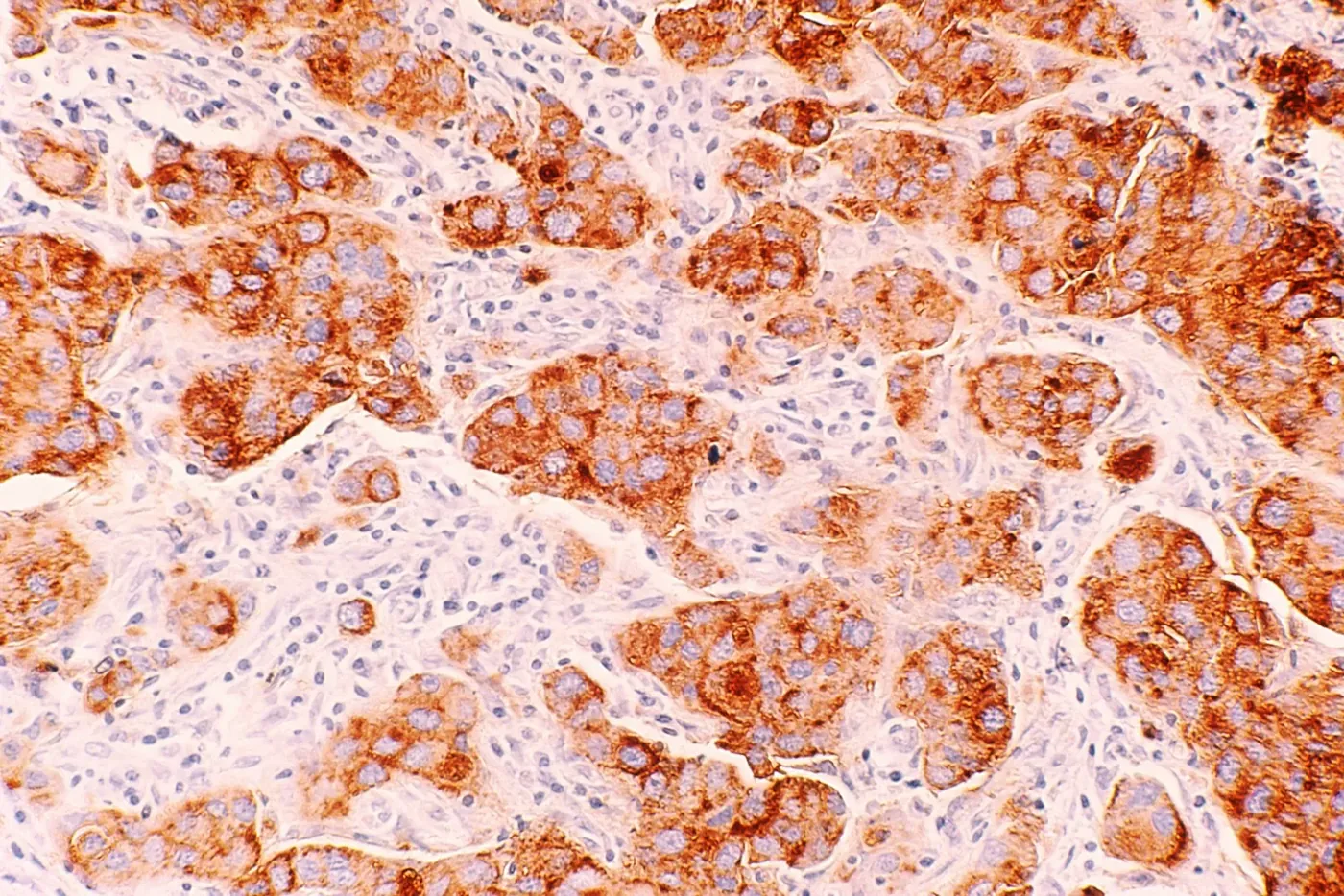Corte de tejido revelado con DAB en inmunohistoquímica cromogénica